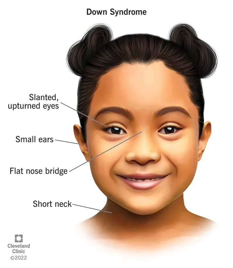 Illustration des traits du visage souvent associés à la trisomie 21 : yeux en amande orientés vers le haut, petites oreilles, arête du nez aplatie et cou court